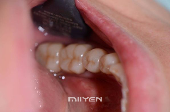 Bloque de zirconio dental multicapa UT