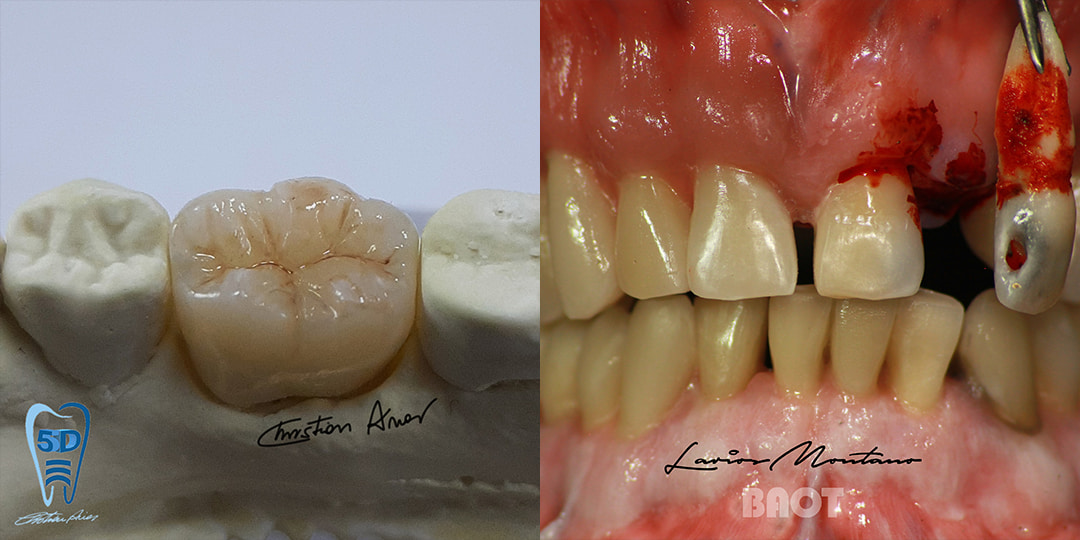 Puente de porcelana dental dentina transparente